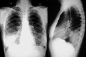 Raios x de pulmões comprometidos pela pneumonia