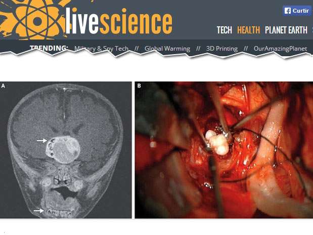 O dente teria sido produzido por um tumor de tipo bastante raro, segundo informações do site Live Science Foto: Reprodução